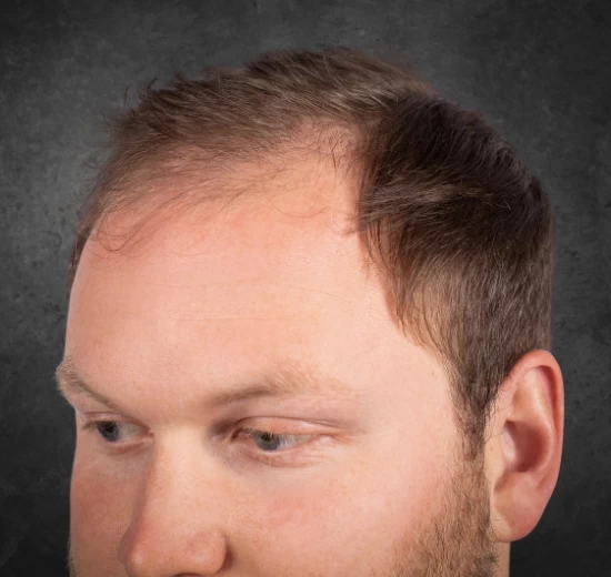 Thicken It Scalp Coverage Powders Easy Application (1)